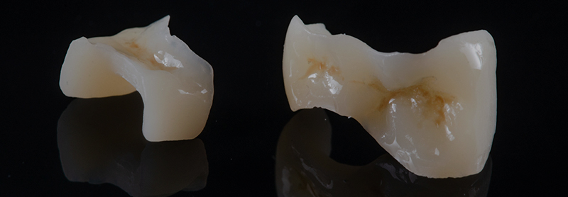 Inlays-maquilles-Imprimante-3D-Lanoiselée