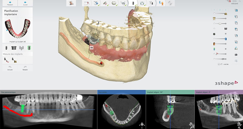 Plannification-implantaire-Imprimante-3D-Lanoiselée