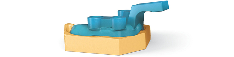 Porte-empreinte-impression-3D-Lanoiselée