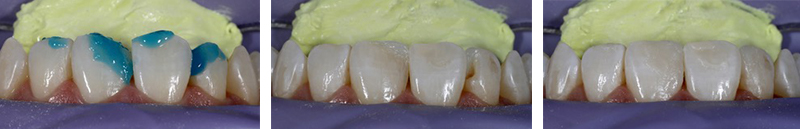 Article-alignement-Fig-4-Restauration
