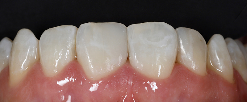 Article-alignement-Fig-4bis-Avant-Réhydratation