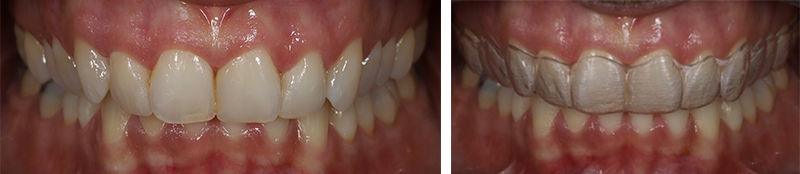 Article-alignement-Fig-6-Avec-Sans-Gouttieres
