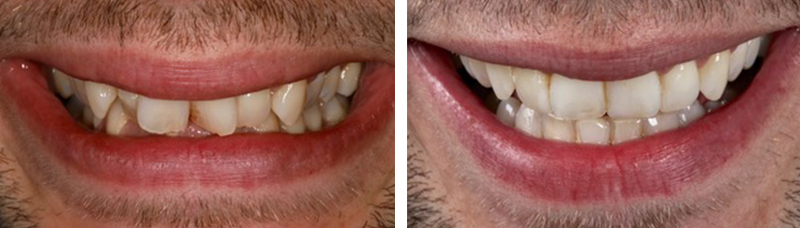 Article-Invisalign-Fig-7-Avant-Après-2