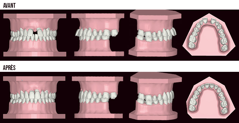 Montage-cas-1-avant-après