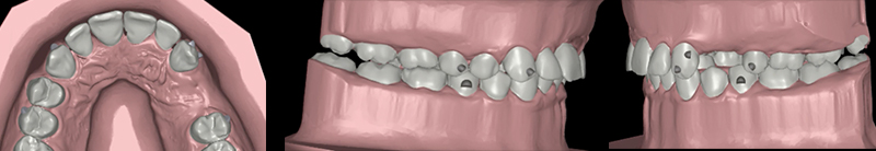 Montage-cas-2-après