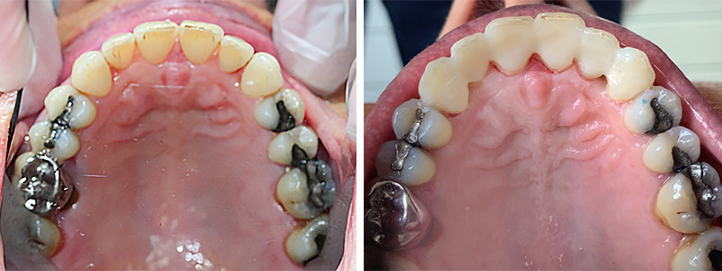 Resultat-avant-contention
