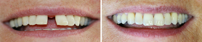 Résultat-avant-après