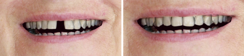 Simulation-avant-après