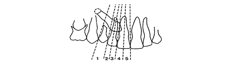 Image-canine-inclusive-maxillaire-Developpement-8ans