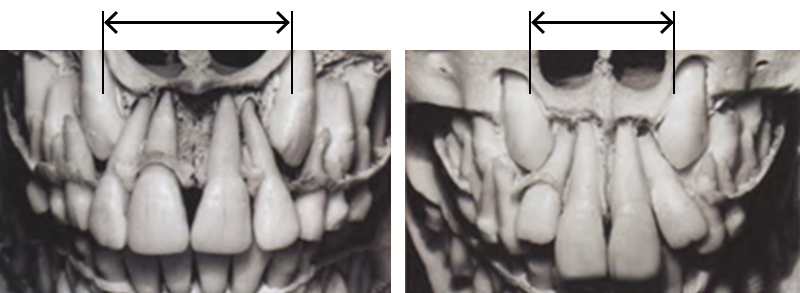 Image-canine-inclusive-maxillaire-Fosses-nasales