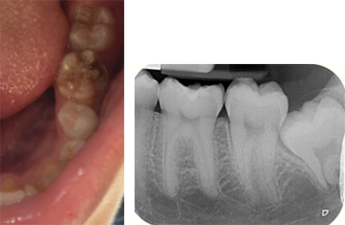 Images-cliniques-Colgate