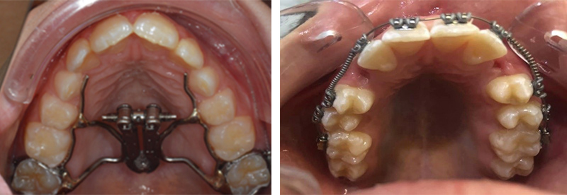 Image-canine-inclusive-maxillaire-Appareil-dentaire