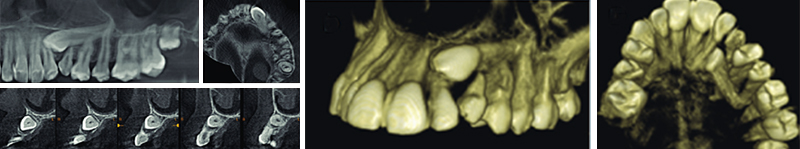 Image-canine-inclusive-maxillaire-CBCT