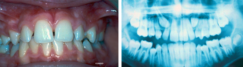 Image-canine-inclusive-maxillaire-Definition-Olivier-Sandid