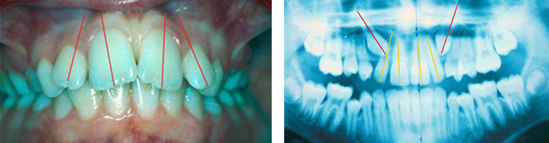Image-canine-inclusive-maxillaire-Distance-intercanine