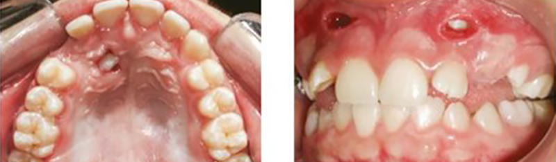 Image-canine-inclusive-maxillaire-Incidence-Olivier-Sandid