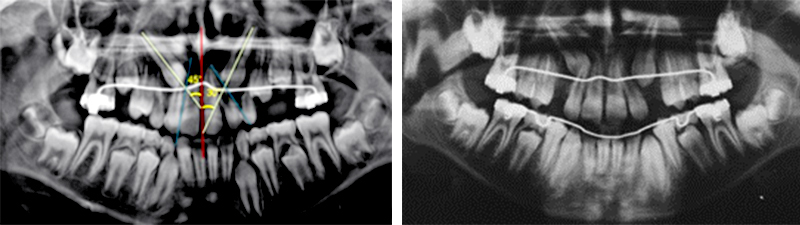 Image-canine-inclusive-maxillaire-Interception