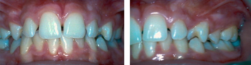 Image-canine-inclusive-maxillaire-Morphologie-Anormale