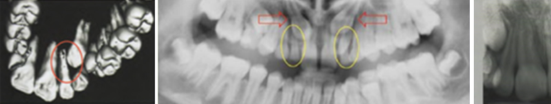 Image-canine-inclusive-maxillaire-Morphologie-anormale-incisive-laterale