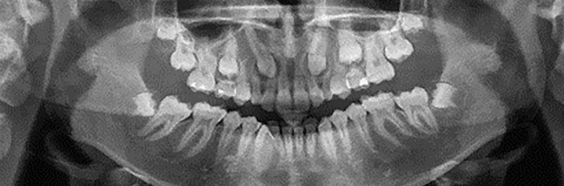 Image-canine-inclusive-maxillaire-Panoramique-dentaire-depistage