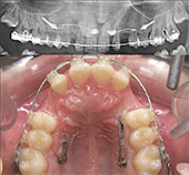 Image-canine-inclusive-maxillaire-Traction-posterieure-mini-implant