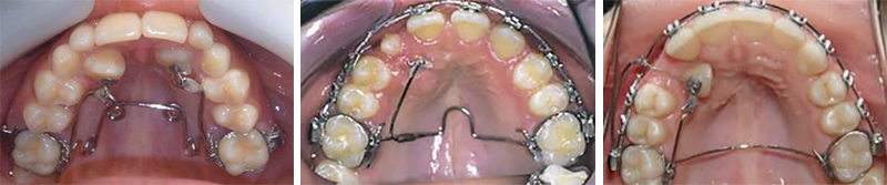 Image-canine-inclusive-maxillaire-Traction-posterieure