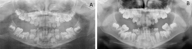 Radiographies-Pano-Enfants