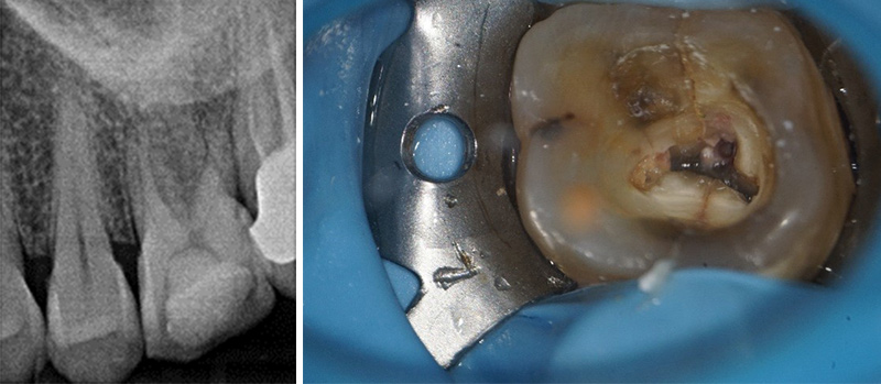 Figure-01-Les-Tutos-Endo-3F-Boublil