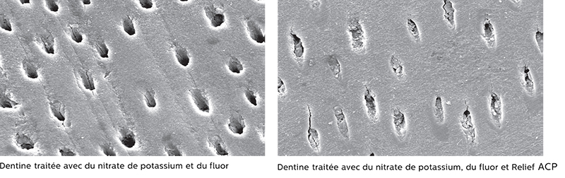 Figure1-Dentine-traitée-HSB