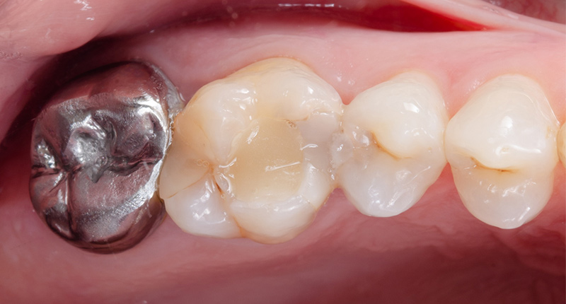 Fig-02_Permanent-Crown