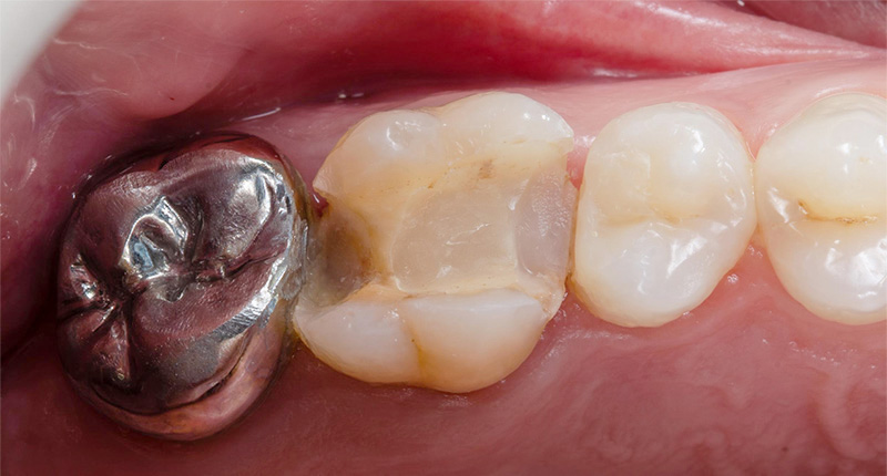 Fig-03_Permanent-Crown