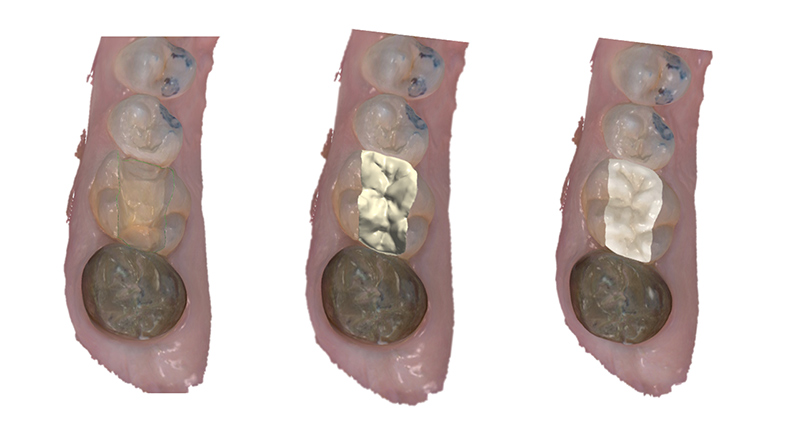 Fig-05_Permanent-Crown