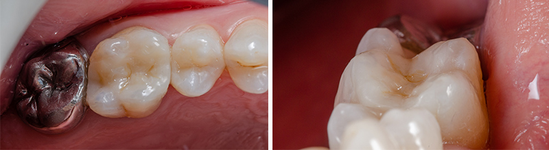 Fig-12_Permanent-Crown