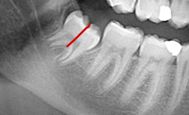 Panoramique-Zoom-Dents-de-sagesse-Philippakis