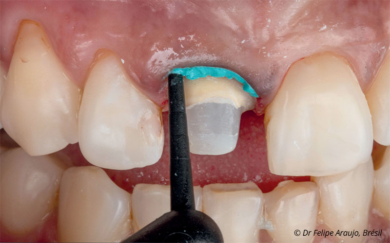 voco-retraction-paste-clinique