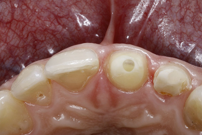 la vue incisale de la dent 21 montre la présence d’un tenon radiculaire