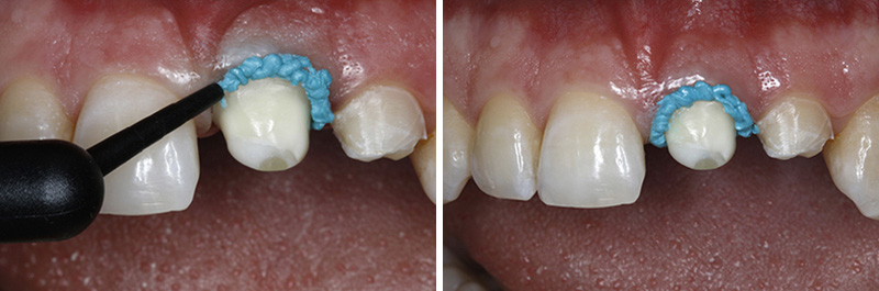 mise en place d’un fil de rétraction très fin