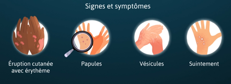 fig-05-ansell-dermatite