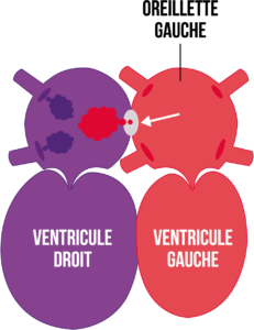 Figure1-article-cardiopathie-congenitale
