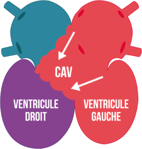 Figure4-article-cardiopathie-congenitale