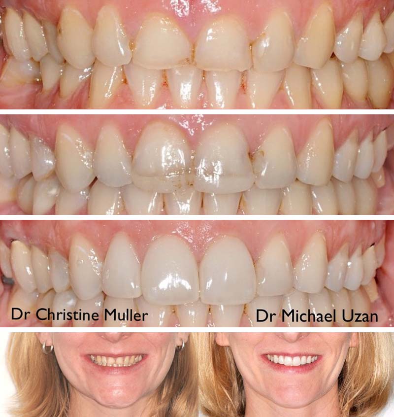 Photo-3-Article-Orthodontie-sur-mesure-Ons-Alouini
