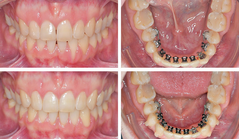 Photo-4-Article-Orthodontie-sur-mesure-Ons-Alouini