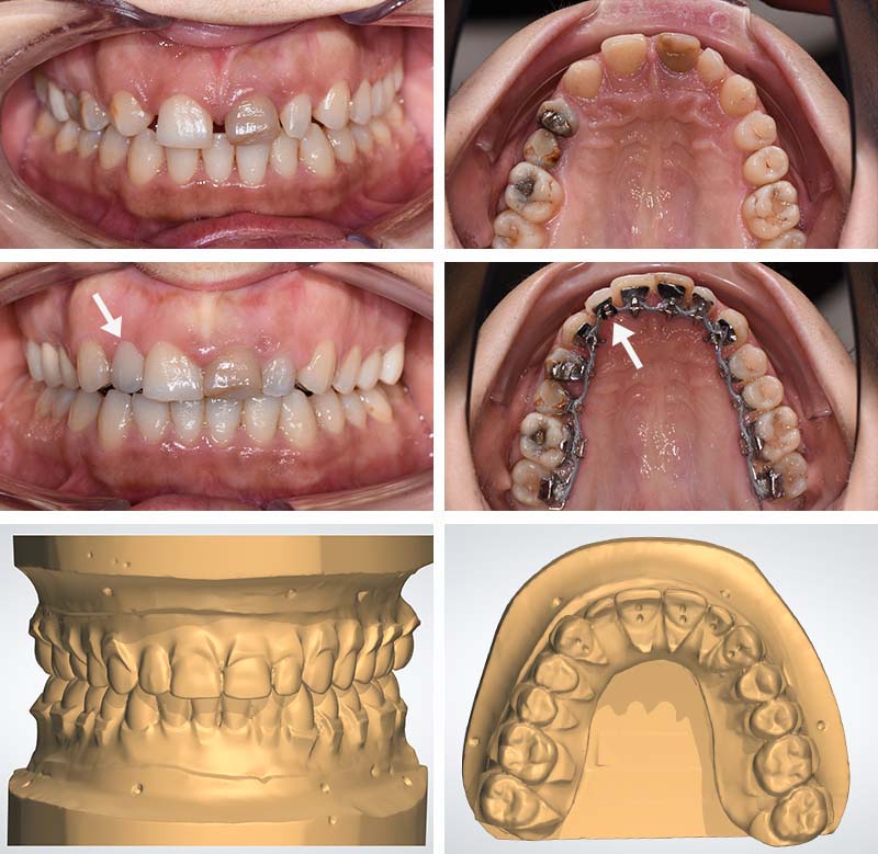 Photo-5-Article-Orthodontie-sur-mesure-Ons-Alouini-Fleches