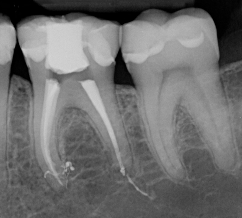 fig02-obturation-academie-sourire-endodontique