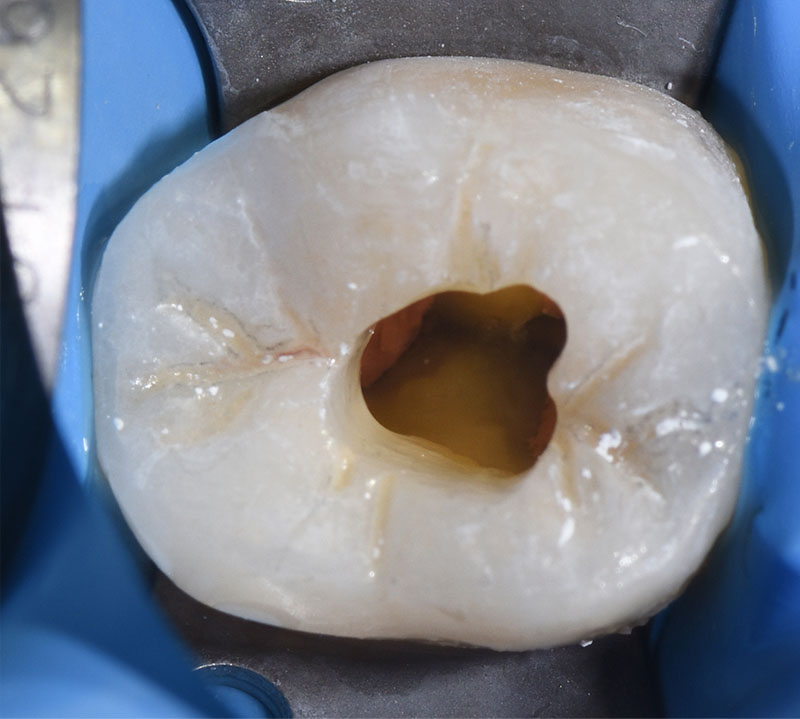 fig03-obturation-academie-sourire
