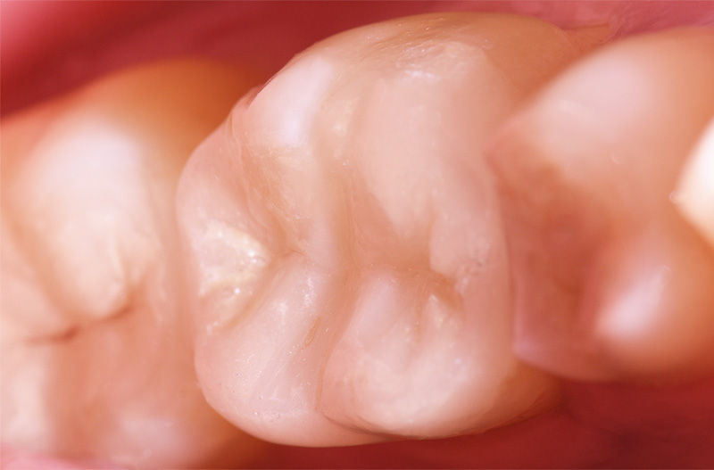 fig04-obturation-academie-sourire