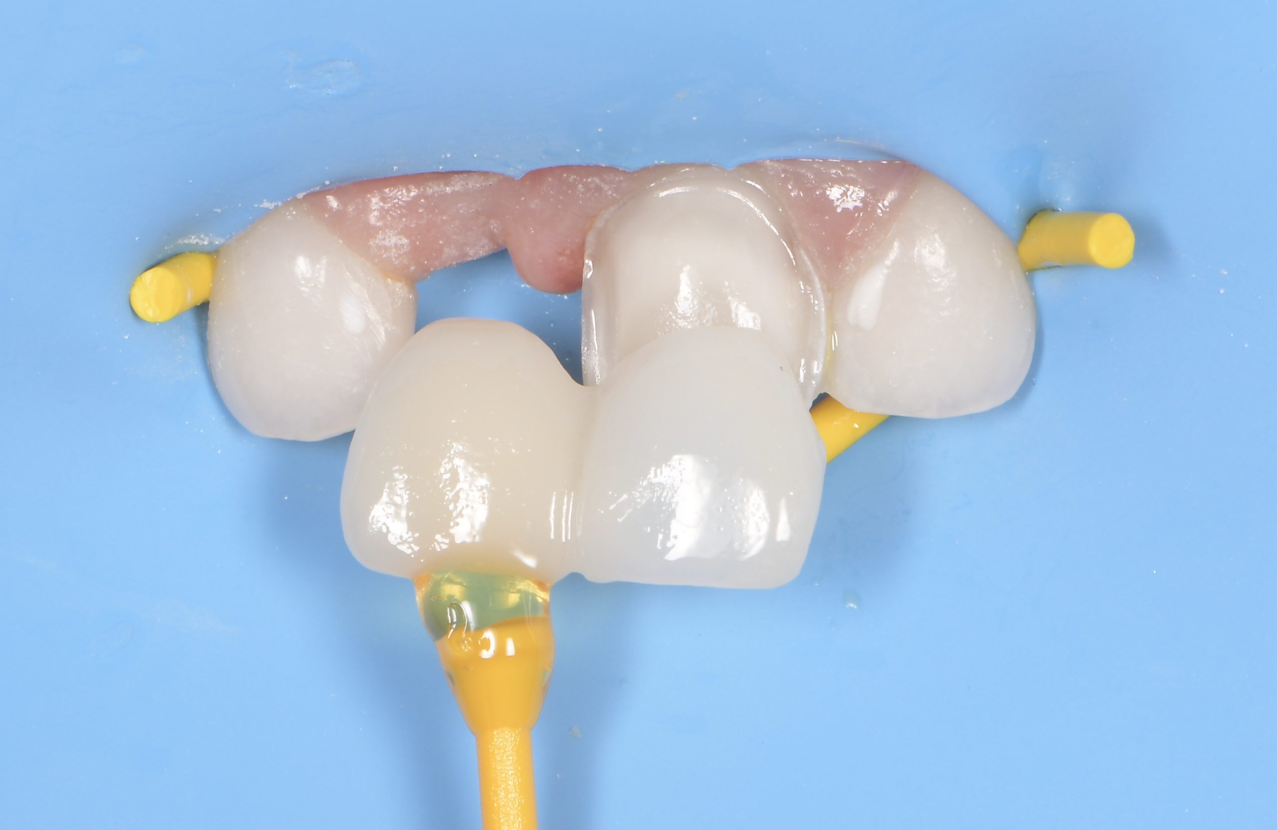 Figure7 - bridge cantilever pédiatrique