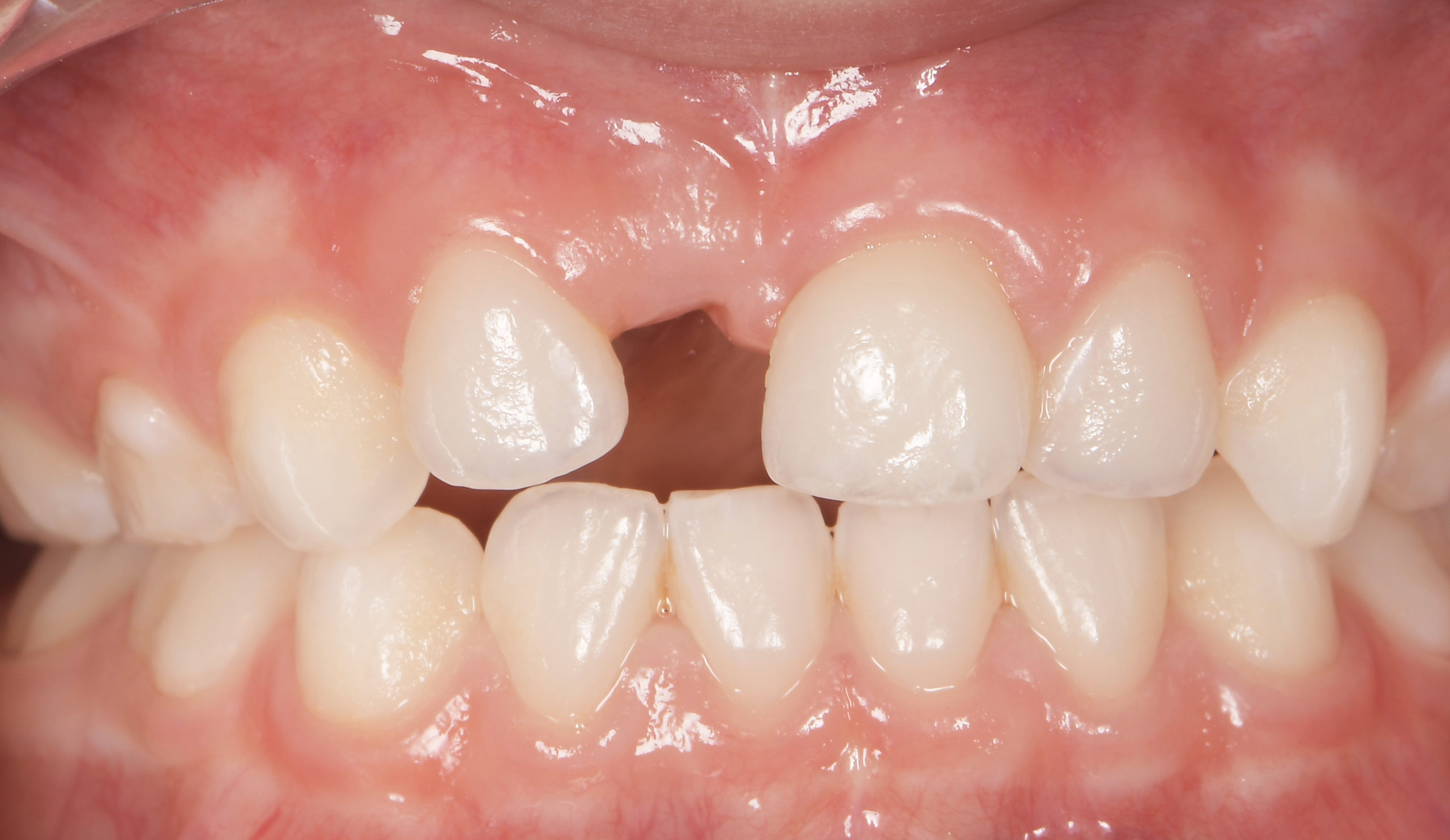 Figure0 - bridge cantilever pédiatrique