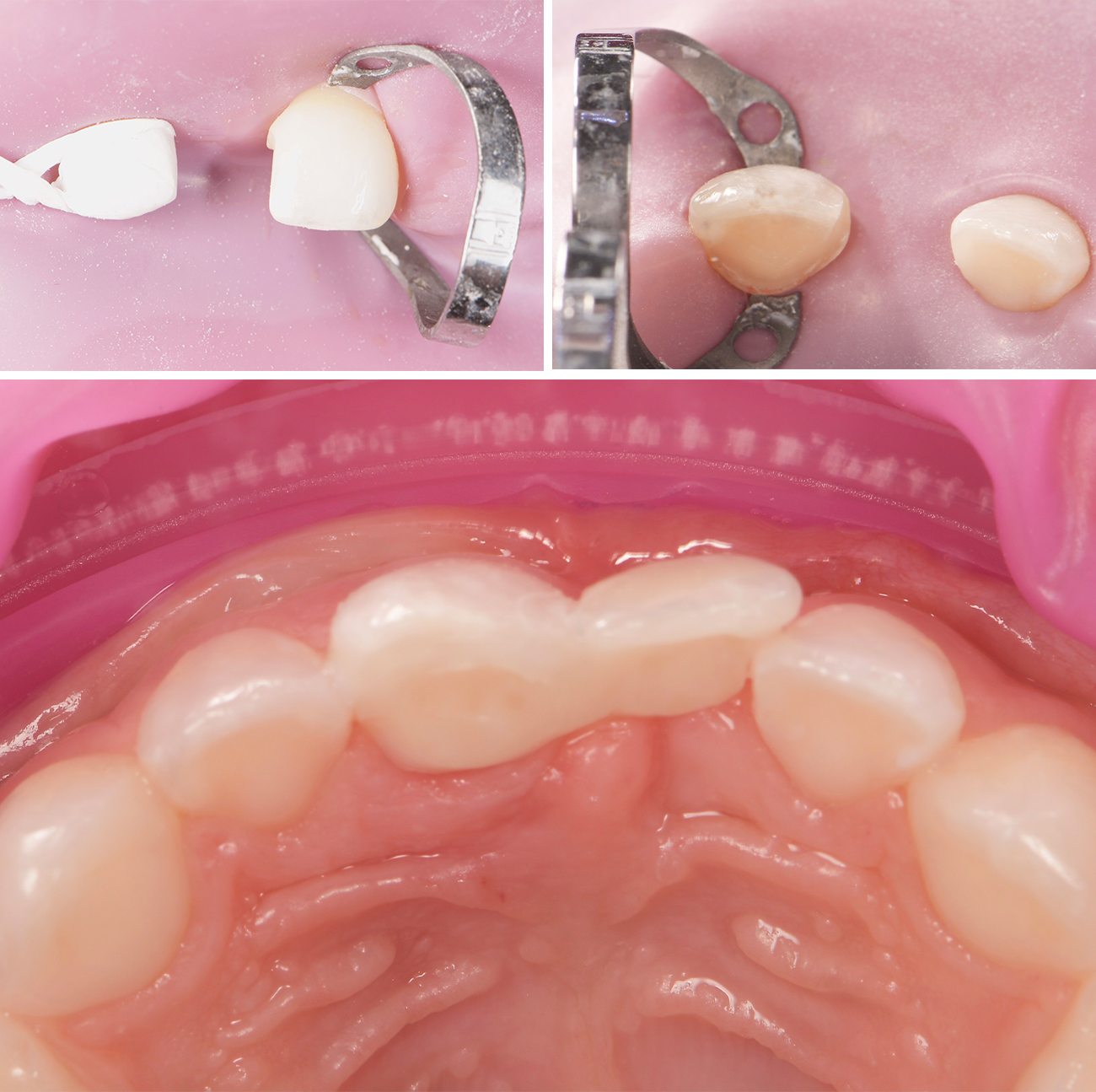 Figure3abc - mainteneur d’espace antérieur collé