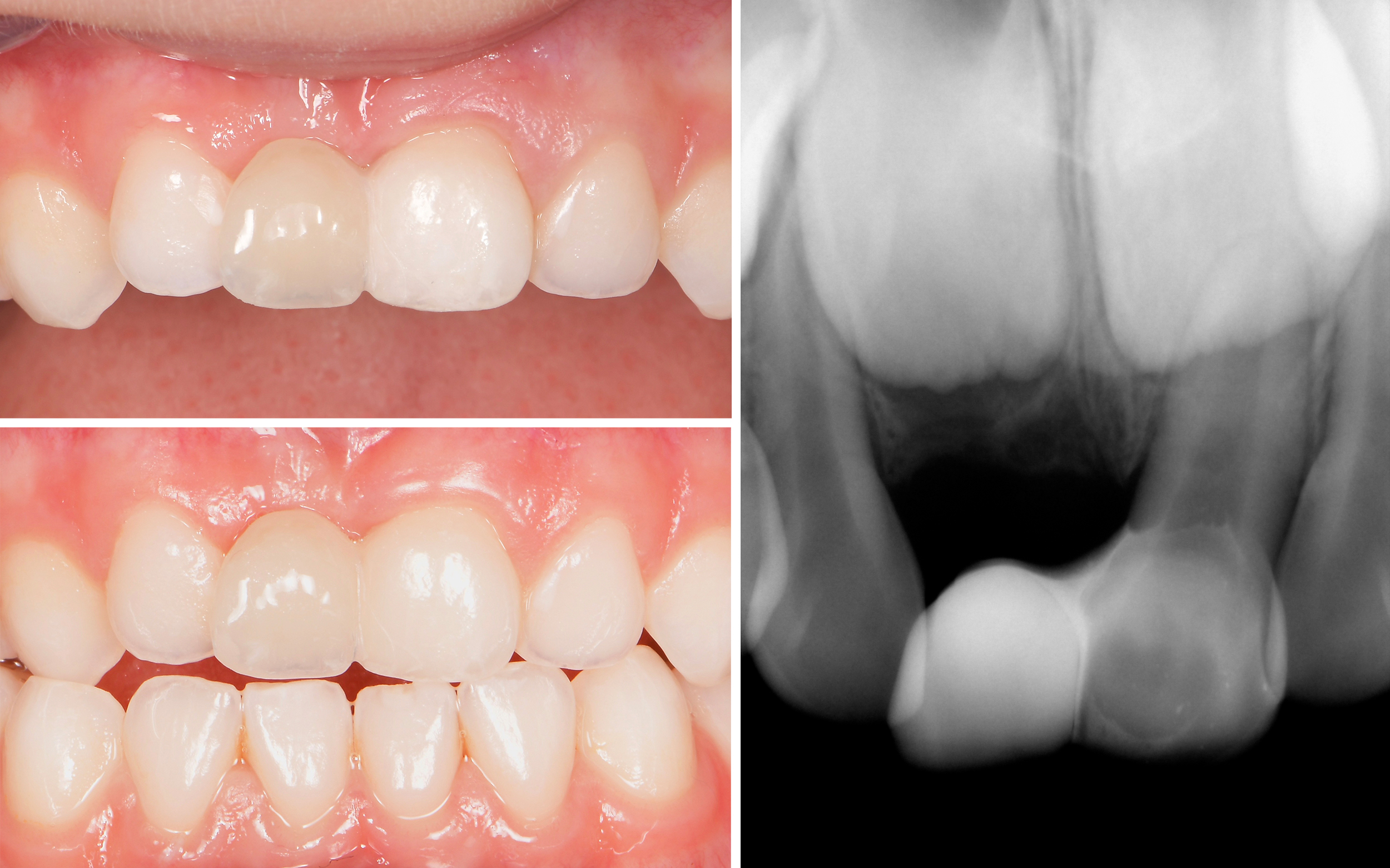 Figure4abc-mainteneur d’espace antérieur collé